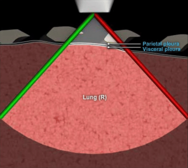 Ultrasound anatomy for right lung zones R1 and R2.
