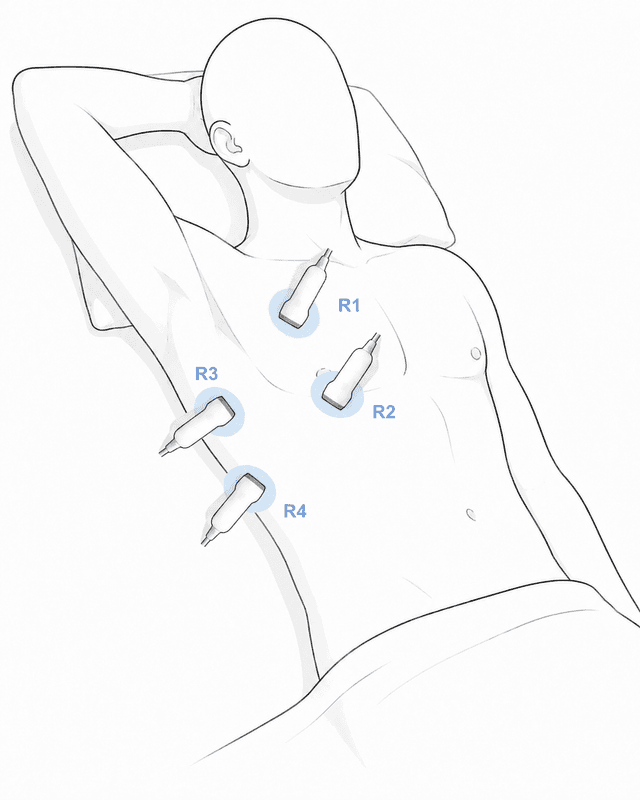Probe positions for the four right lung ultrasound zones.